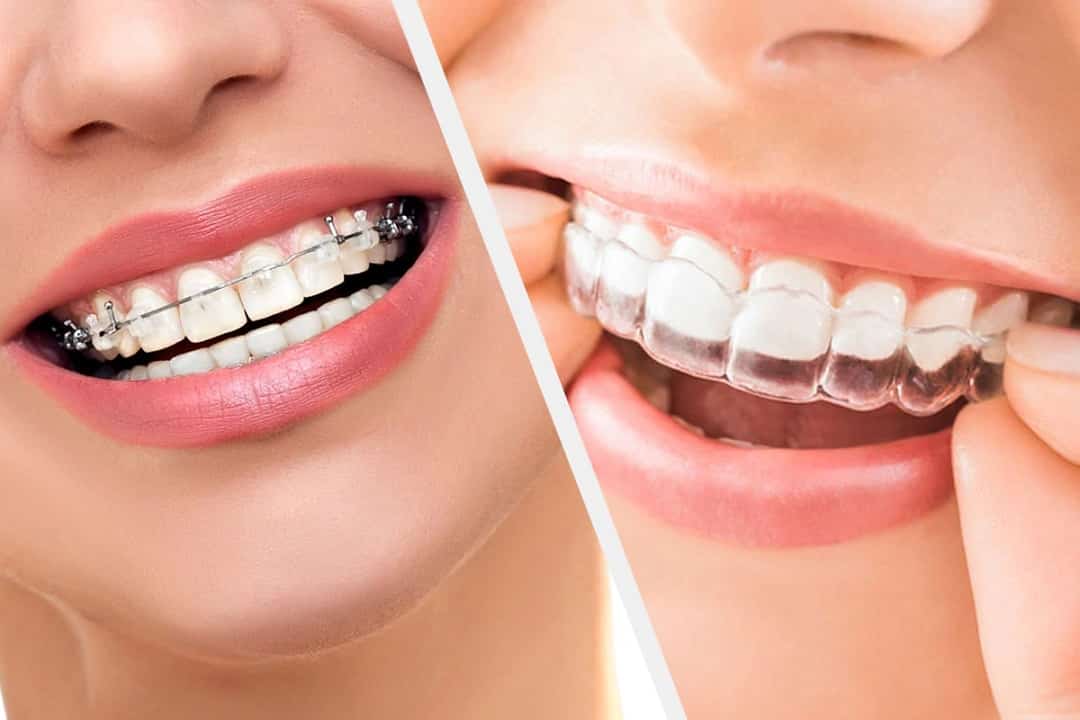 Orthodontic braces and clear aligners