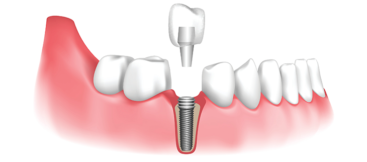 Implant supported tooth