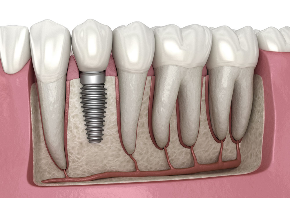 Dental implant components