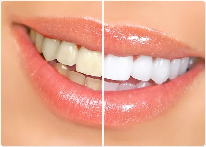Porcelain veneers smile