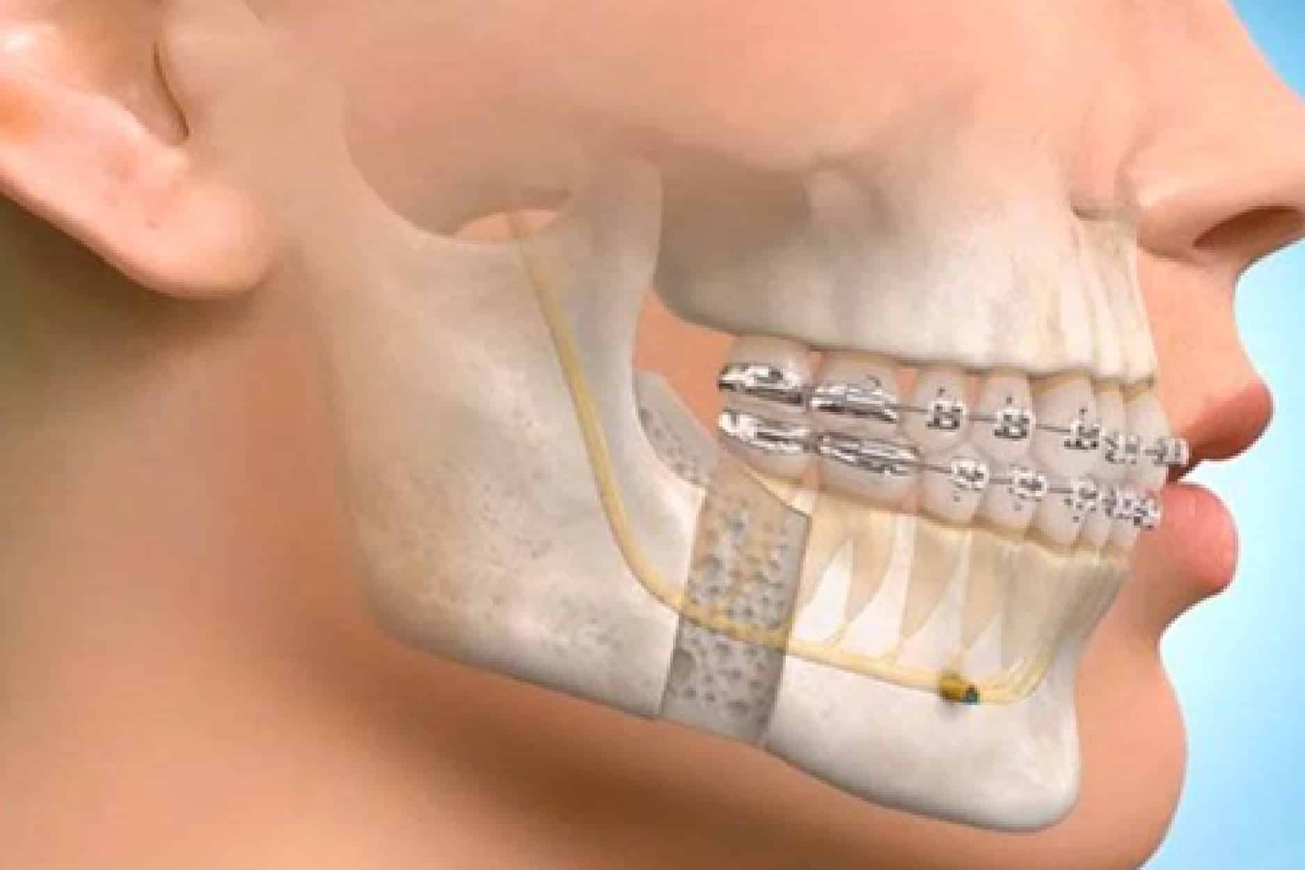 Jaw surgery planning