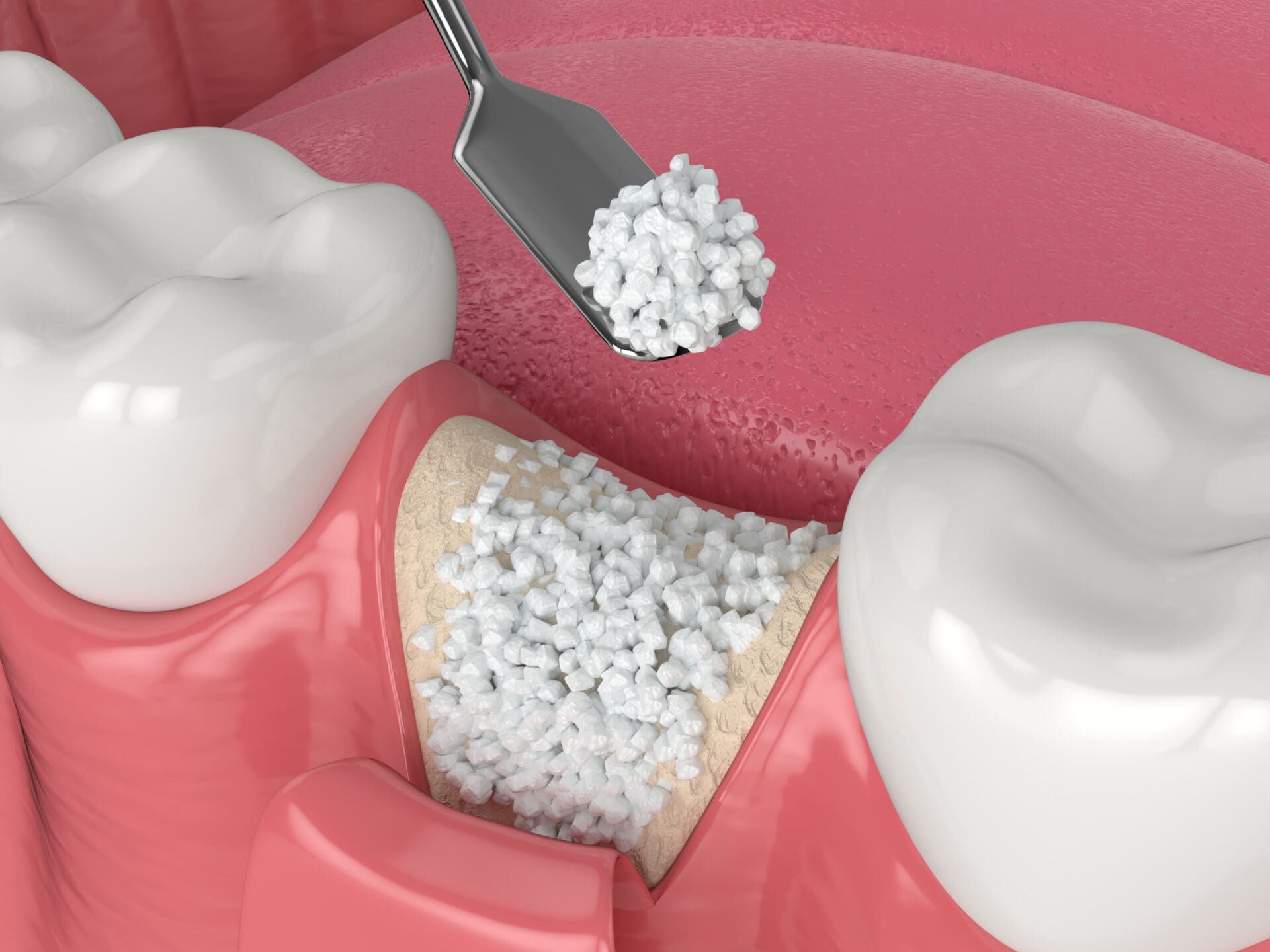Bone graft materials