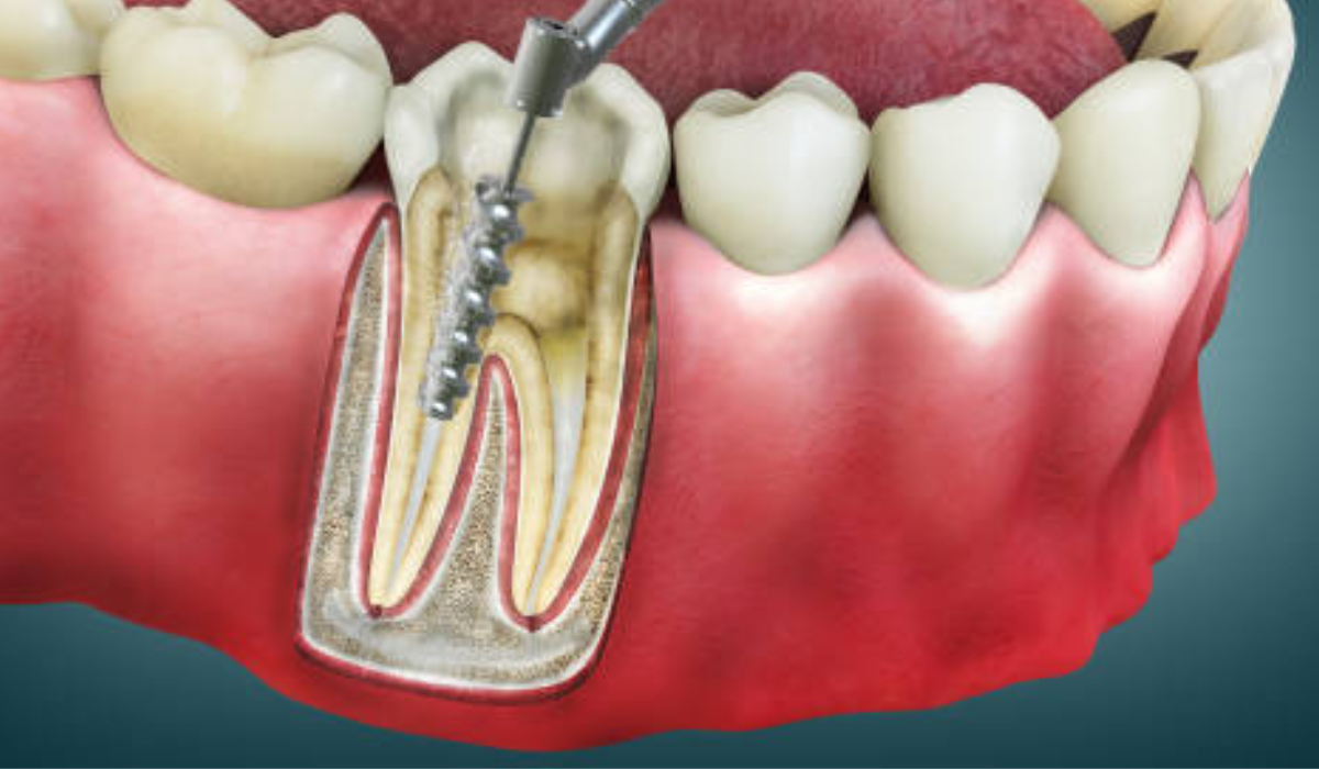 Root canal treatment equipment